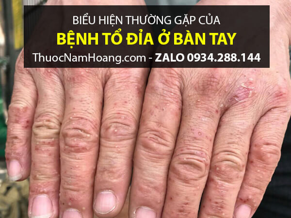 Những mức độ thường thấy khi bị nổi mụn nước