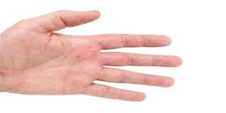 Lòng bàn tay bị ngứa nổi hột