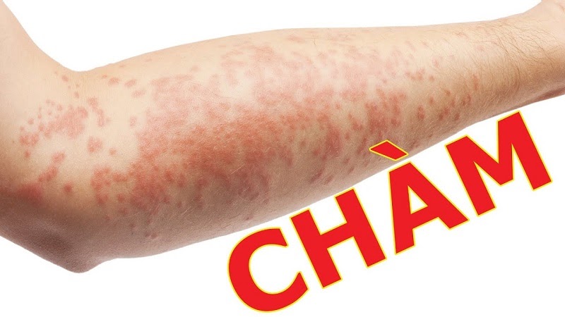 bệnh chàm ezema