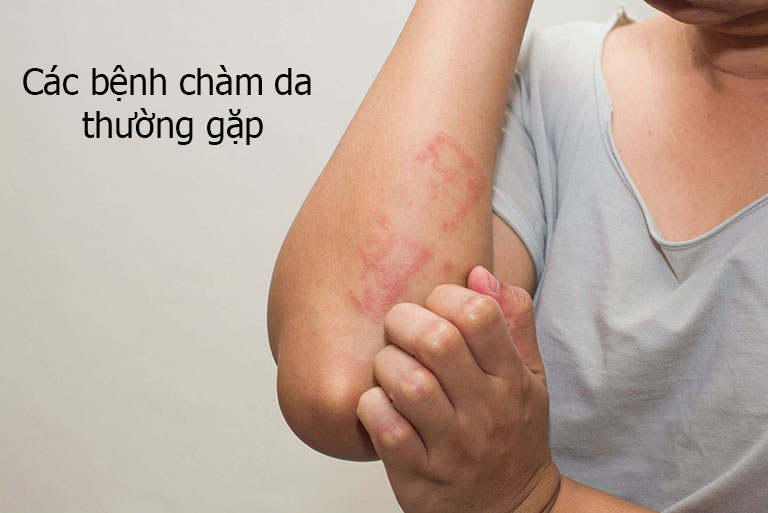 Bệnh chàm (Eczema) là gì