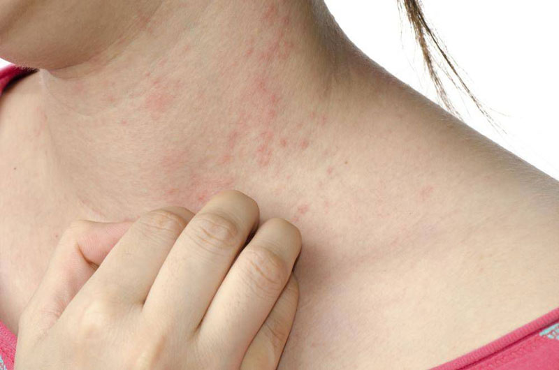 Nguyên Nhân gây bệnh chàm Eczema