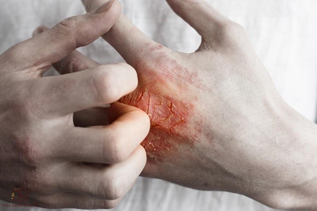 Phân loại bệnh chàm Eczema