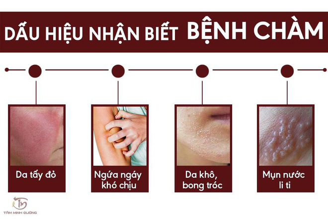Triệu chứng của loại bệnh chàm