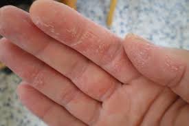 Bệnh chàm có nguy hiểm không?