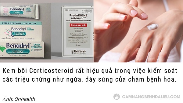 cách trị viêm da chàm hoá bằng thuốc tây