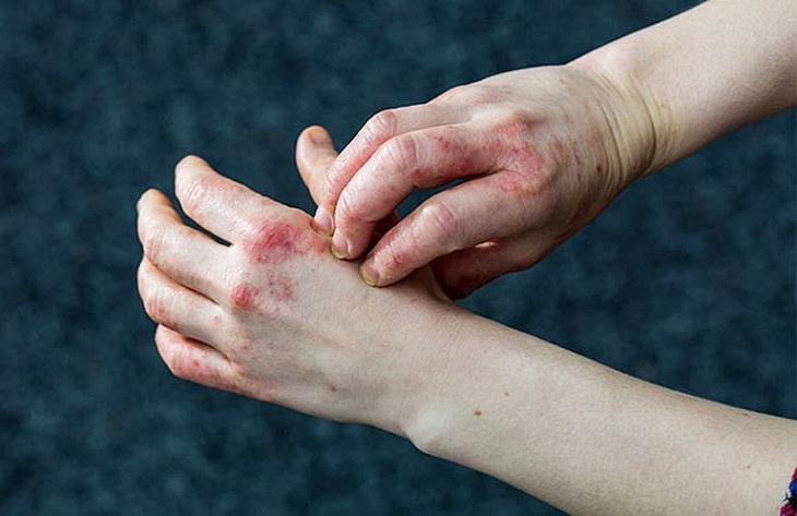 cách trị viêm da chàm hoá