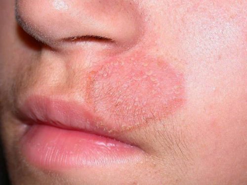 rủi ro ngoại vi gây ra bệnh chàm đồng tiền