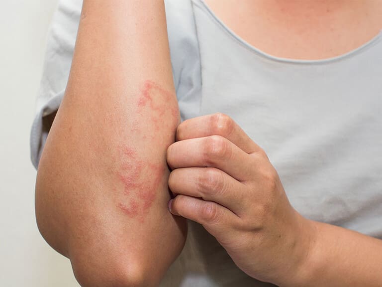 cách trị bệnh chàm