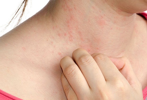 cách trị bệnh chàm bằng dân gian