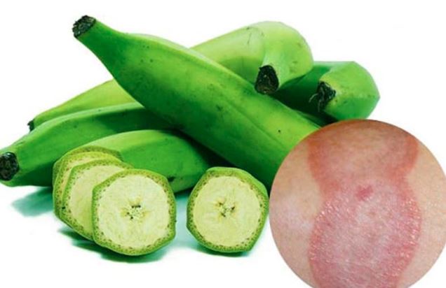 Cách trị chàm bằng chuối xanh