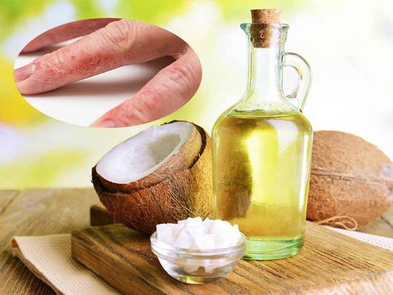 Cách trị bệnh chàm bằng dầu dừa