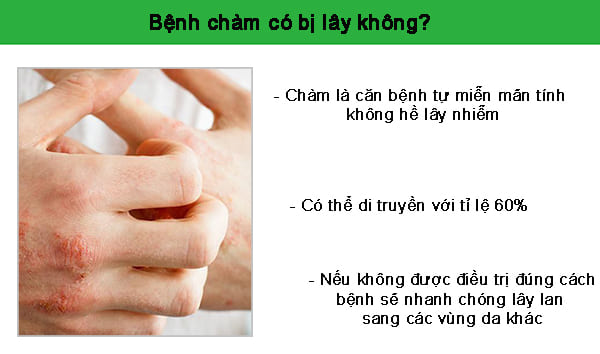 bệnh chàm có lây không