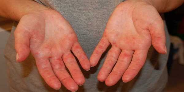bệnh chàm có di truyền không