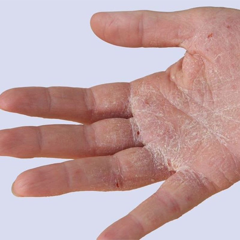 Bị chàm có chữa được không?