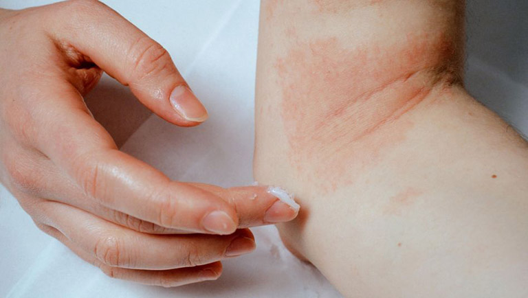 bôi thuốc trị chàm