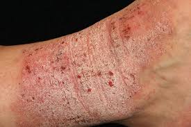 Cách chẩn đoán bệnh chàm ở tay chân