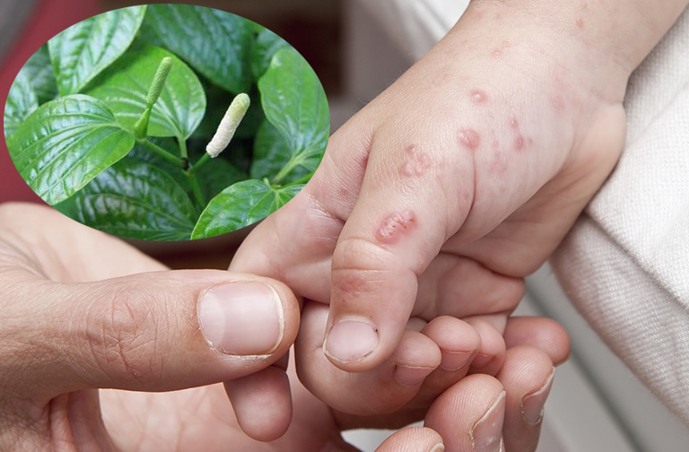 Chữa chàm bội nhiễm bằng Lá Lốt