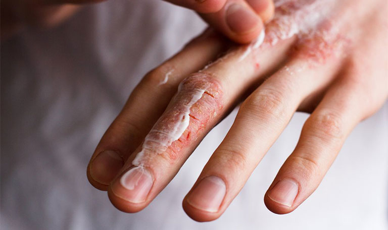 dấu hiệu bệnh chàm khô đầu ngón tay