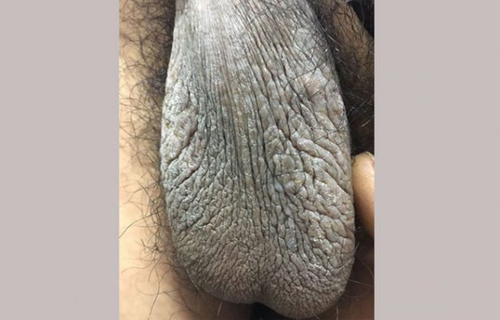 hình ảnh chàm bìu dạng tương đối