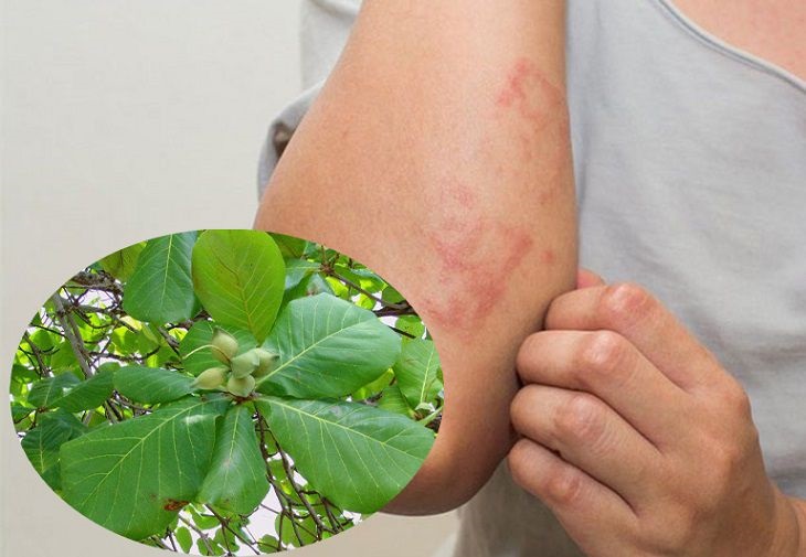 cách chữa chàm bằng lá bàng