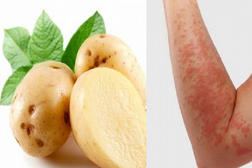 cách chữa bệnh chàm bằng khoai tây