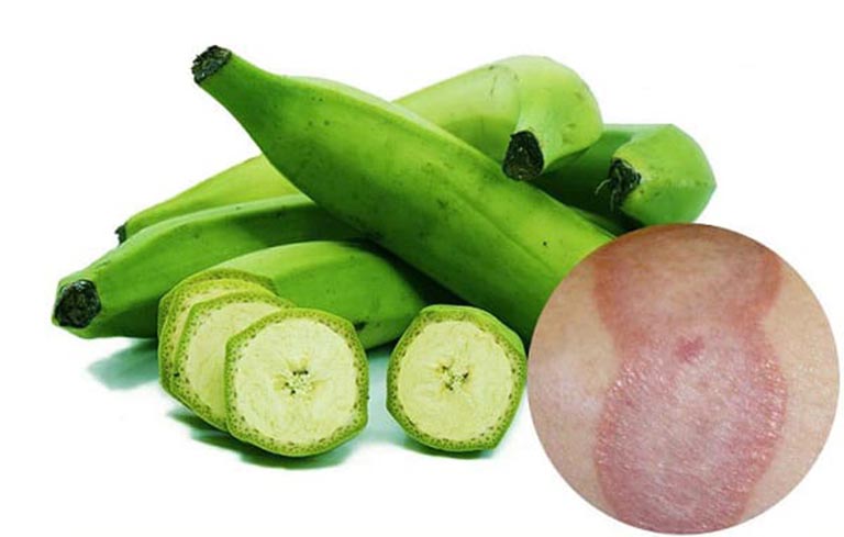 cách chữa chàm bằng chuối xanh