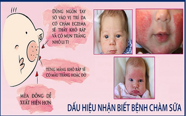 Triệu chứng bệnh chàm sữa ở trẻ sơ sinh