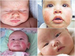 Phân loại bệnh chàm sữa ở trẻ