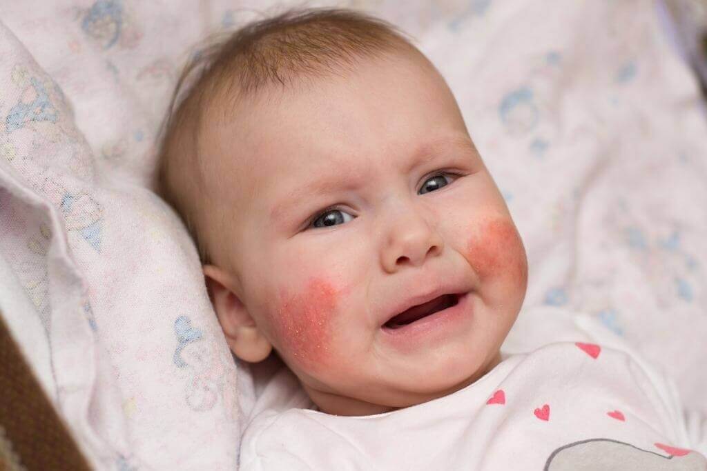 Chế độ ăn cho trẻ bị chàm sữa