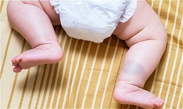 nguyên nhân bị chàm xanh ở trẻ sơ sinh