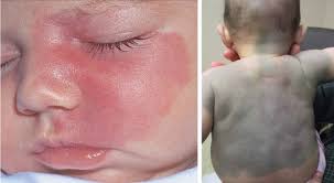 Vết chàm xanh ở trẻ sơ sinh có tự hết không