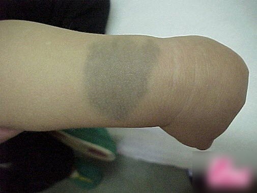 Chàm xanh trên da trẻ sơ sinh có nguy hiểm không