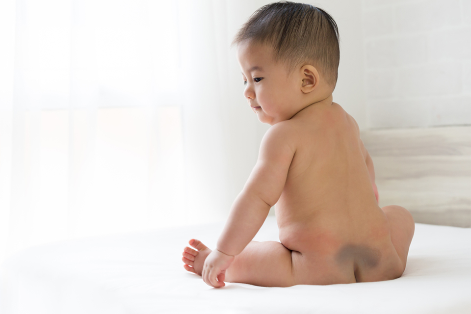 Điều trị chàm xanh bằng phương pháp y khoa