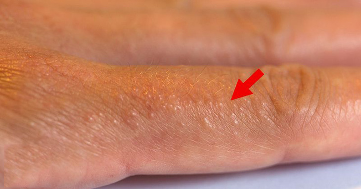 Bệnh chàm nước có nguy hiểm không