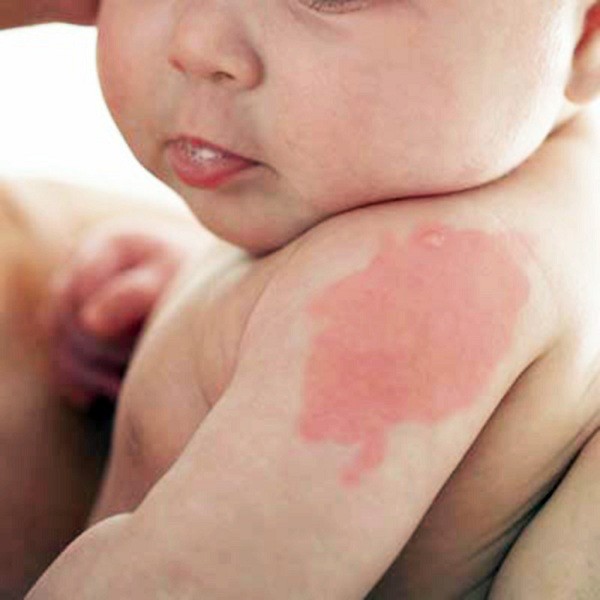 bệnh chàm đỏ ở trẻ sơ sinh