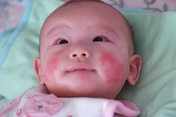 nguyên nhân bệnh chàm đỏ ở trẻ sơ sinh