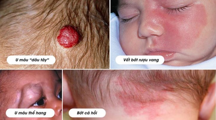 Bớt nevi giãn mao mạch
