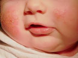 bệnh chàm sữa tự khỏi không