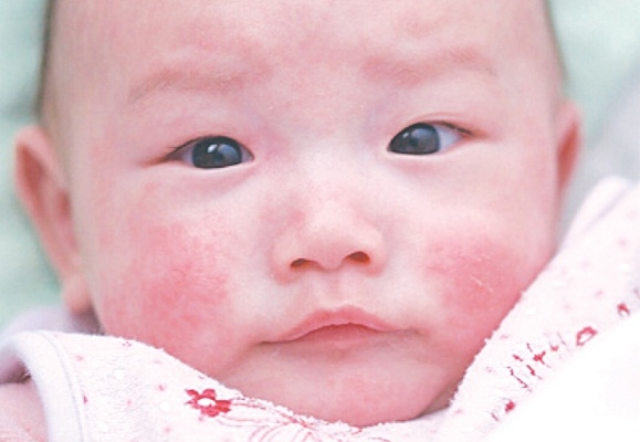 bệnh chàm sữa có tự hết không?