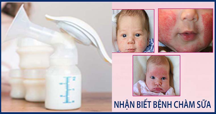 cách trị chàm sữa bằng sữa mẹ
