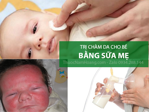 Cách trị chàm sữa bằng sữa mẹ