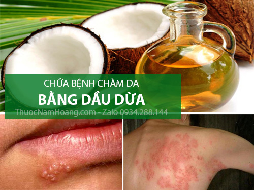 Cách trị chàm sữa bằng dầu dừa có thật sự hiệu quả