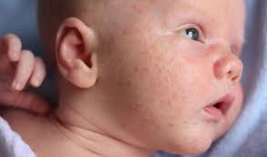 Ưu và nhược điểm lá tắm trị chàm sữa