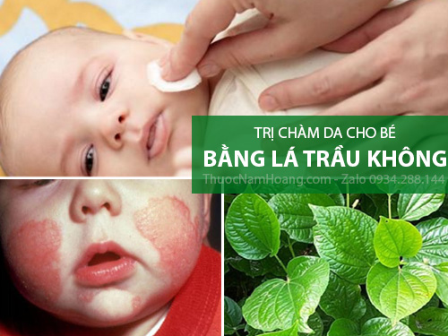 Tinh dầu lá trầu không trị chàm sữa