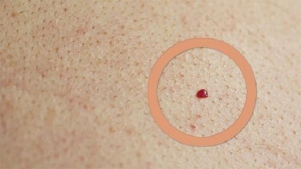 Da nổi chấm đỏ như nốt ruồi son