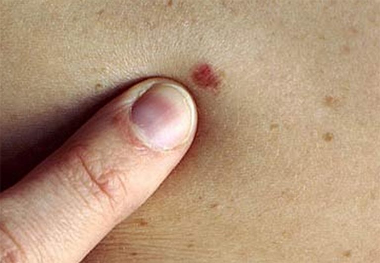 Nổi chấm đỏ trên da như nốt ruồi son