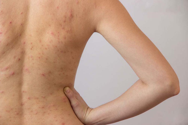 nổi mẩn đỏ ngứa ở lưng