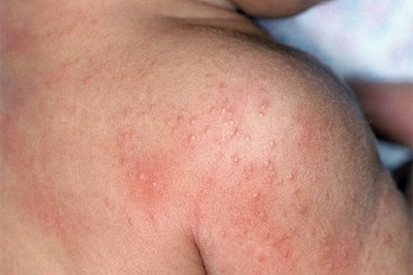 Rôm sảy gây nổi mẩn đỏ ngứa ở sống lưng