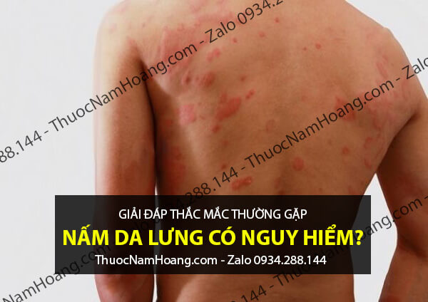 Sử dụng thuốc tây chữa nổi mẩn đỏ ở lưng