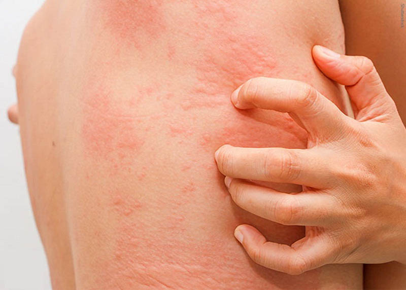 Những nguyên nhân chủ yếu ngứa da về đêm